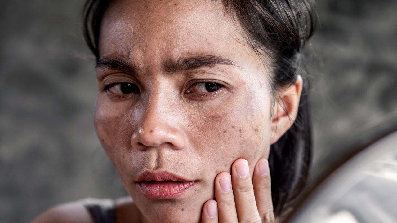 Enlever Les Taches Sur Le Visage Naturellement